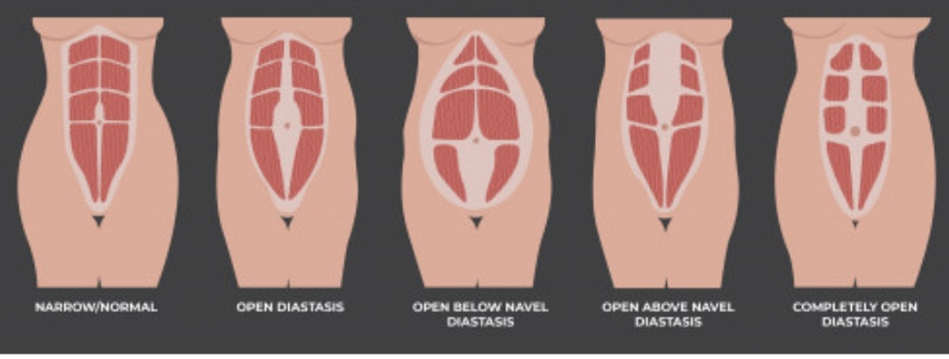diastasis23
