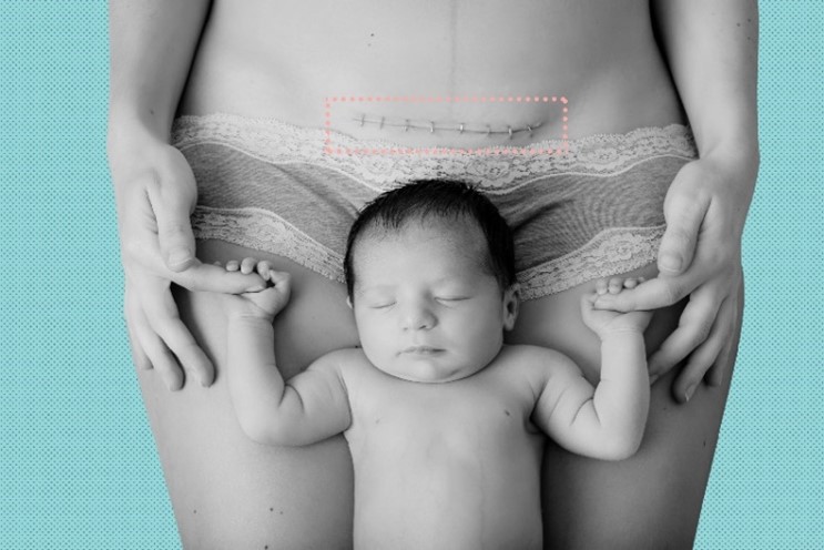 postcaesarian