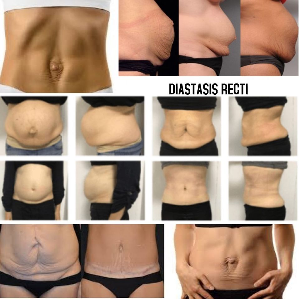 Can I Fix Diastasis Muscle Separation Without a Tummy Tuck?