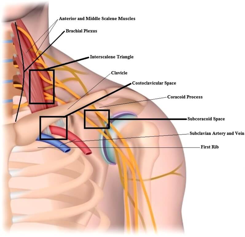 Thoracic Outlet Syndrome: More Than Just a Pain in the Neck – The